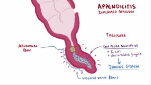 Infograph Diagram of Possible Gangrenous Appendicitis osmosis.org